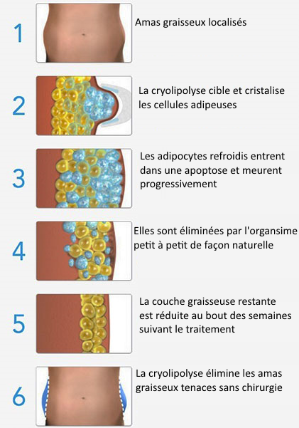 cryolipolyse-sama-welless